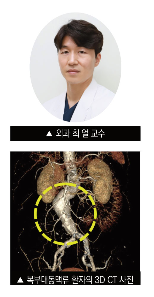 외과 최 얼 교수 복부대동맥류 환자의 3D CT 사진