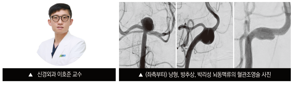 신경외과 이호준 교수 (좌측부터) 낭형,방추상,박리성 뇌동맥류의 혈관조영술 사진