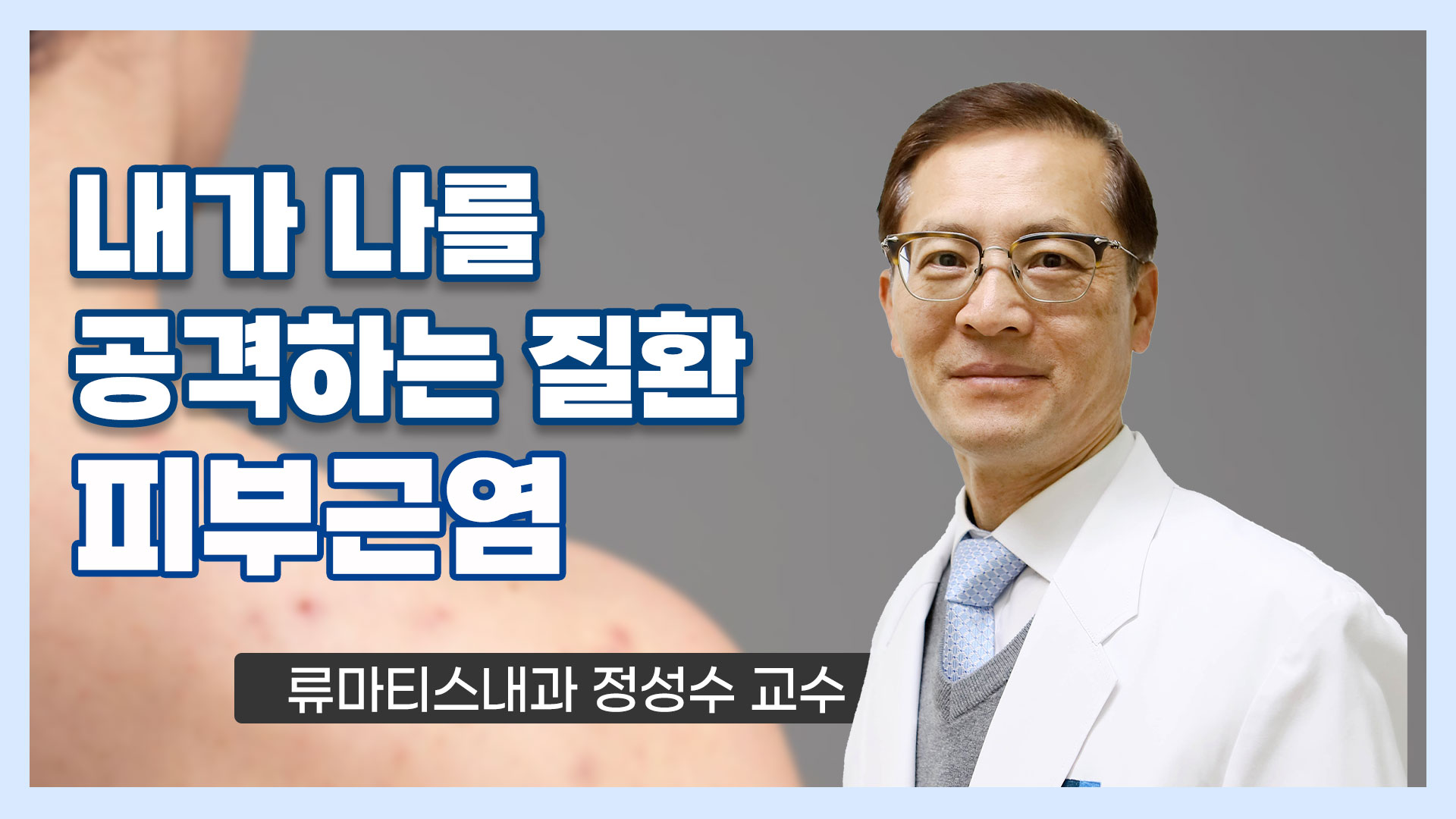 피부근염은 자가면역 질환으로 
피부와 근육에 염증이 발생하는 복잡한 희귀질환입니다.
자가면역 질환의 하나로, 
면역 체계가 자신의 몸의 세포와 조직을 공격하여
염증을 유발하는 병리 과정을 포함하는데요.
오늘은 류마티스내과 정성수 교수님과 함께 희귀질환 중 하나인 '피부근염'에 대해
알아보도록 하겠습니다.