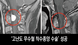 임수빈 신경외과 교수, 서울 대형병원 ‘수술 어렵다’ 판단한 ‘고난도 무수혈 척수종양 수술’ 성공